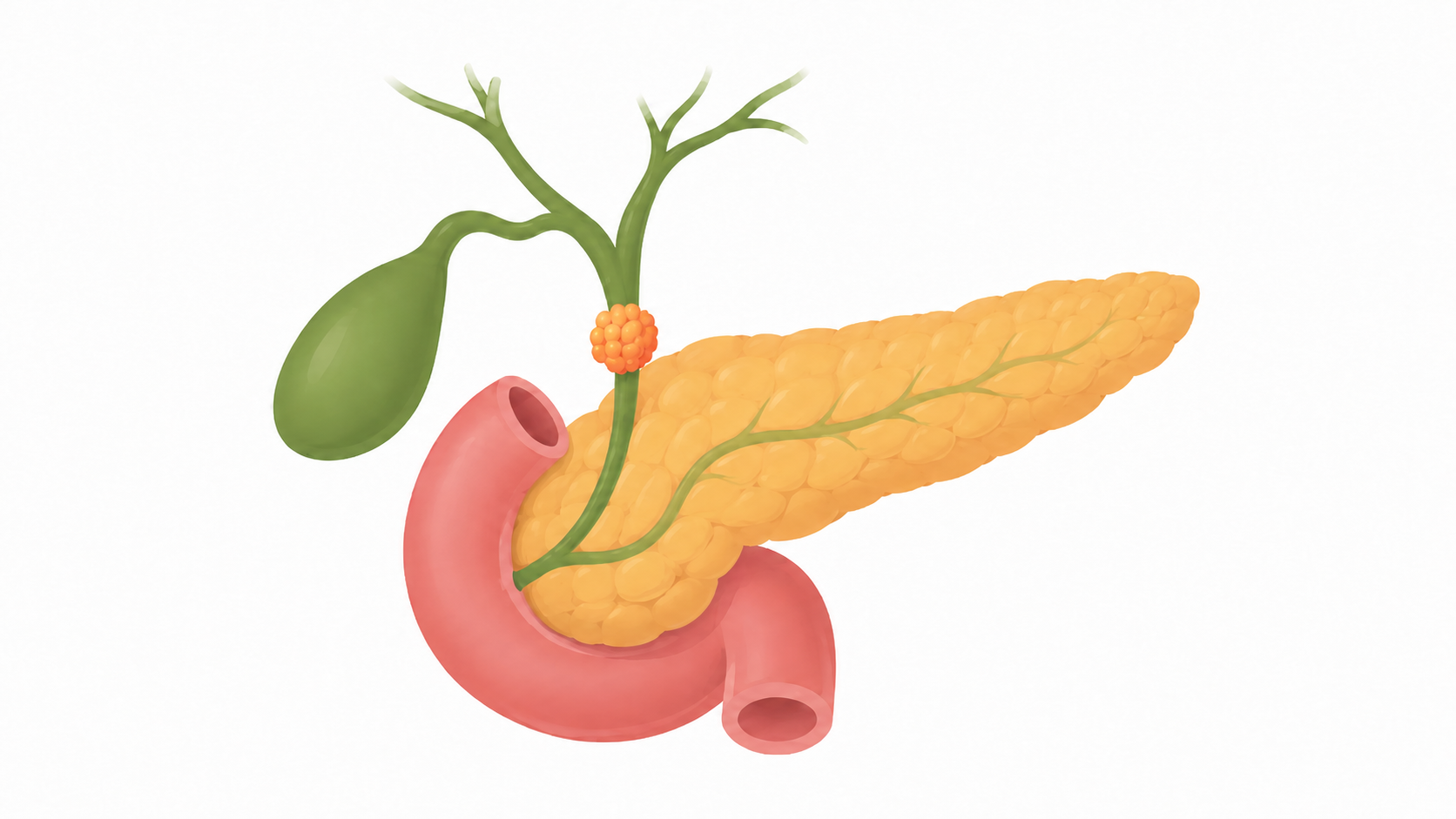 Cholangiocarcinoma
