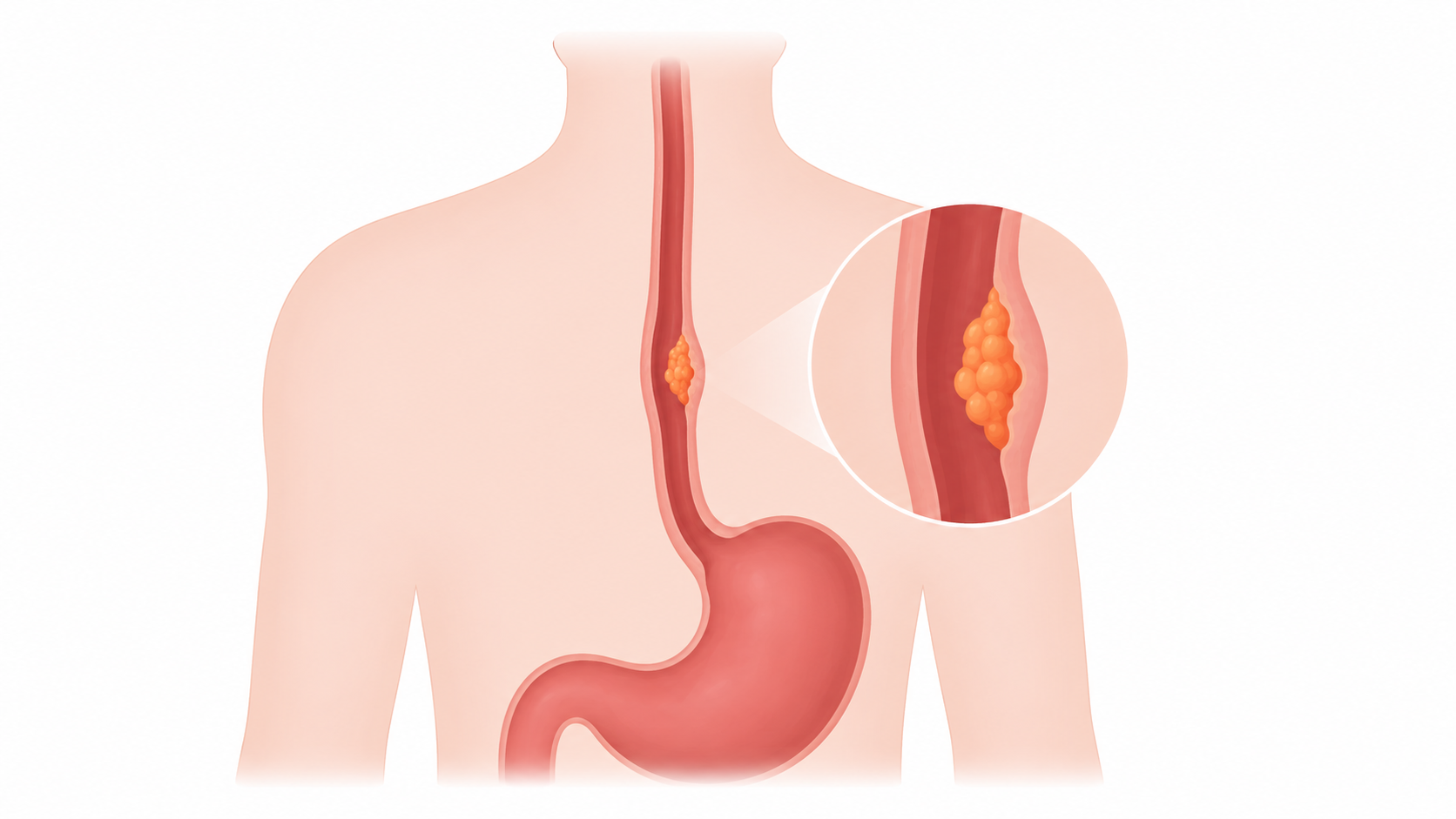 Esophageal Cancer