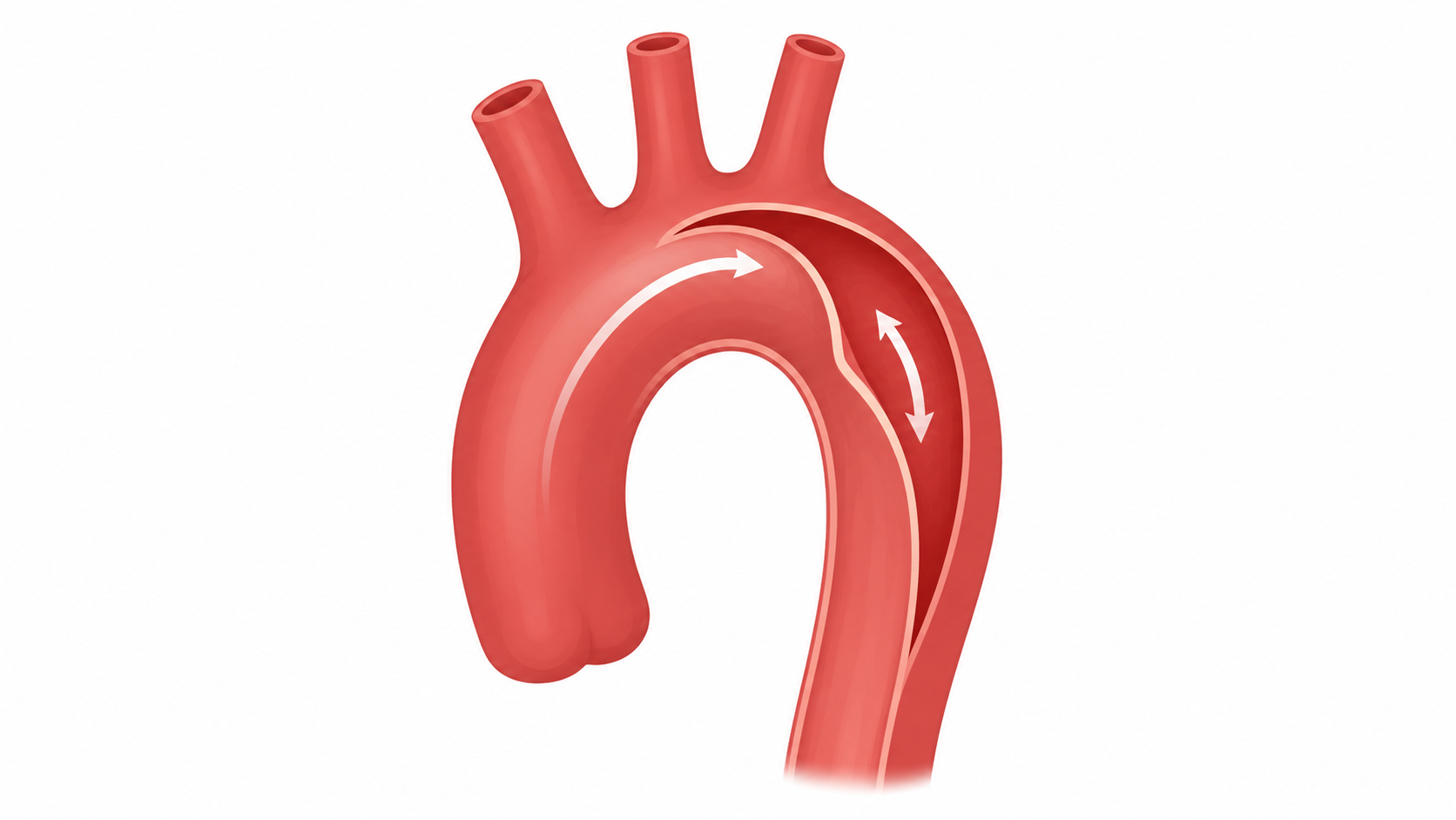 Aortic Dissection